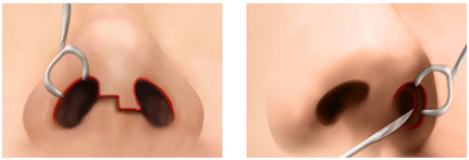 Đường rạch phẫu thuật và Quy trình nâng mũi Sline