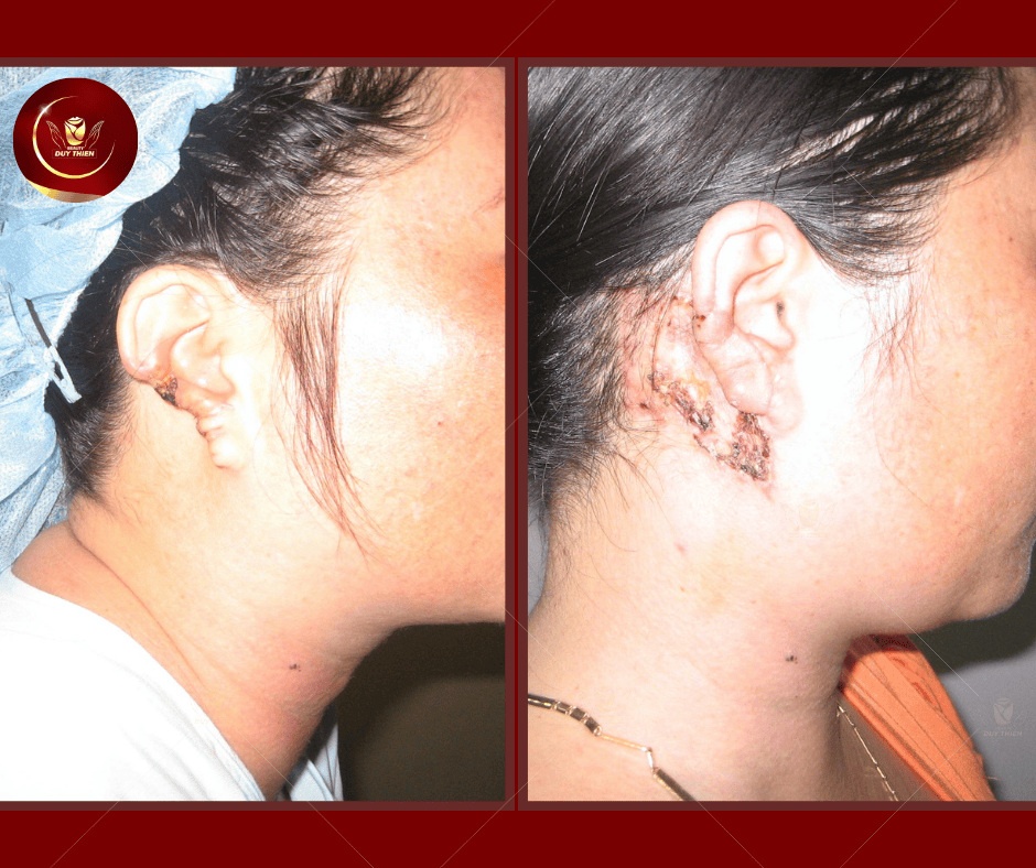 Sau 2 tuần tái khám phần trái tai được tạo hình rõ, vị trí vạc da lấy cấy ghép lành ổn định.