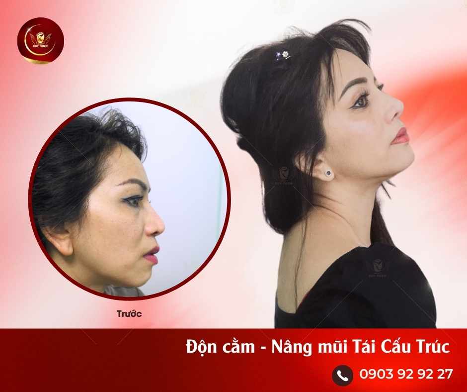 Sau Phẫu thuật Nâng Mũi Tái Cấu Trúc, Độn Cằm