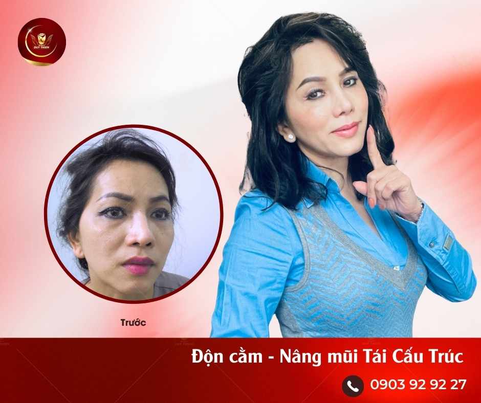 Sau Nâng mũi Tái Cấu Trúc và Độn Cằm