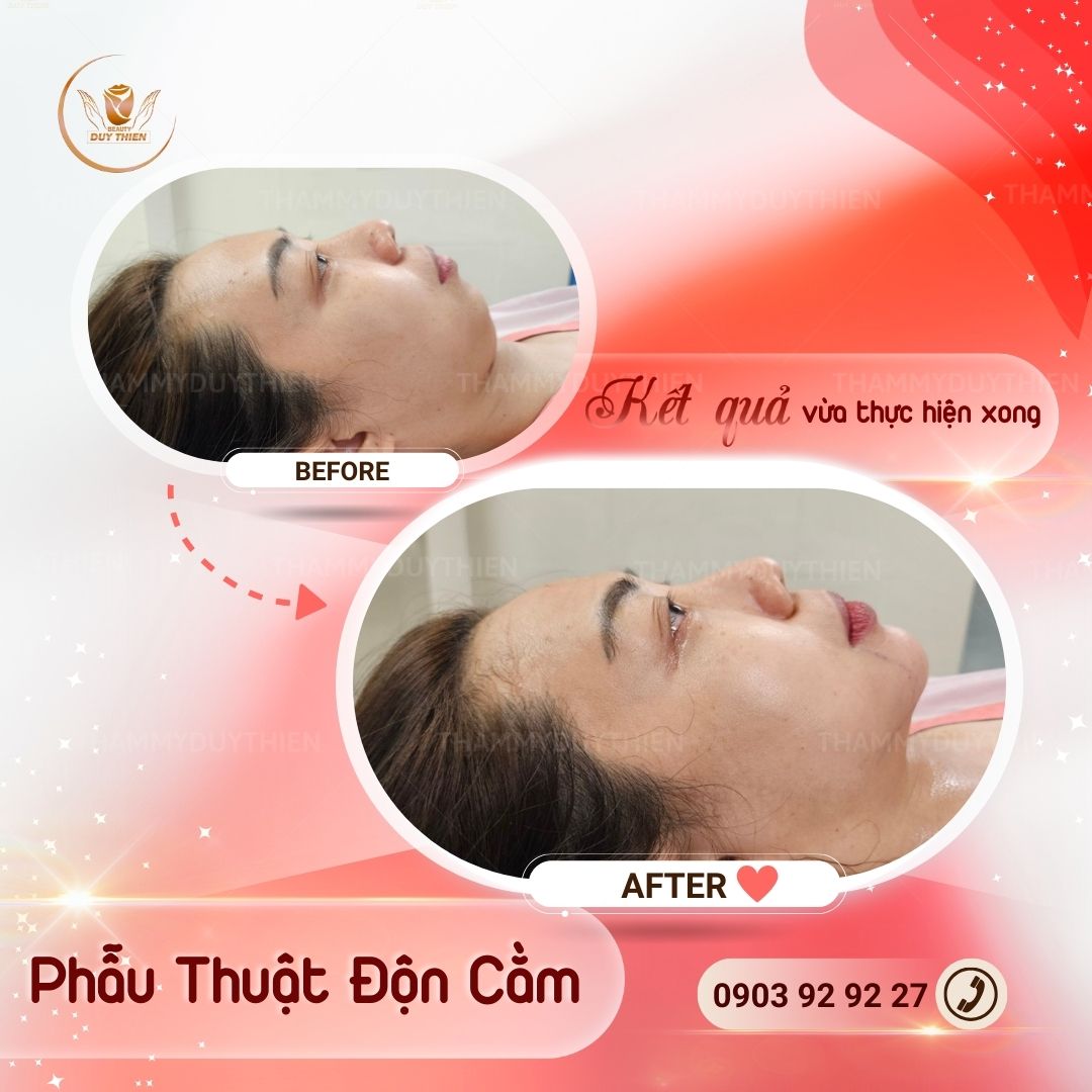 phau-thuat-don-cam-tu-nhien