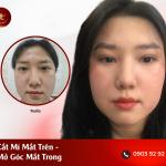 truoc-sau-mo-goc-mat-cat-mat