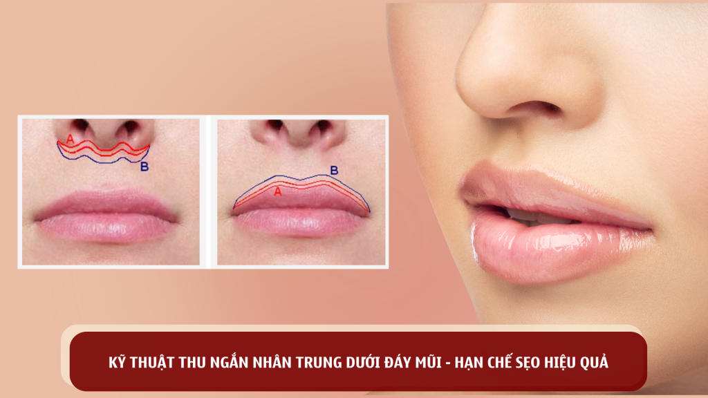 Kỹ thuật Thu Ngắn Nhân Trung dưới đáy mũi - hạn chế sẹo hiệu quả