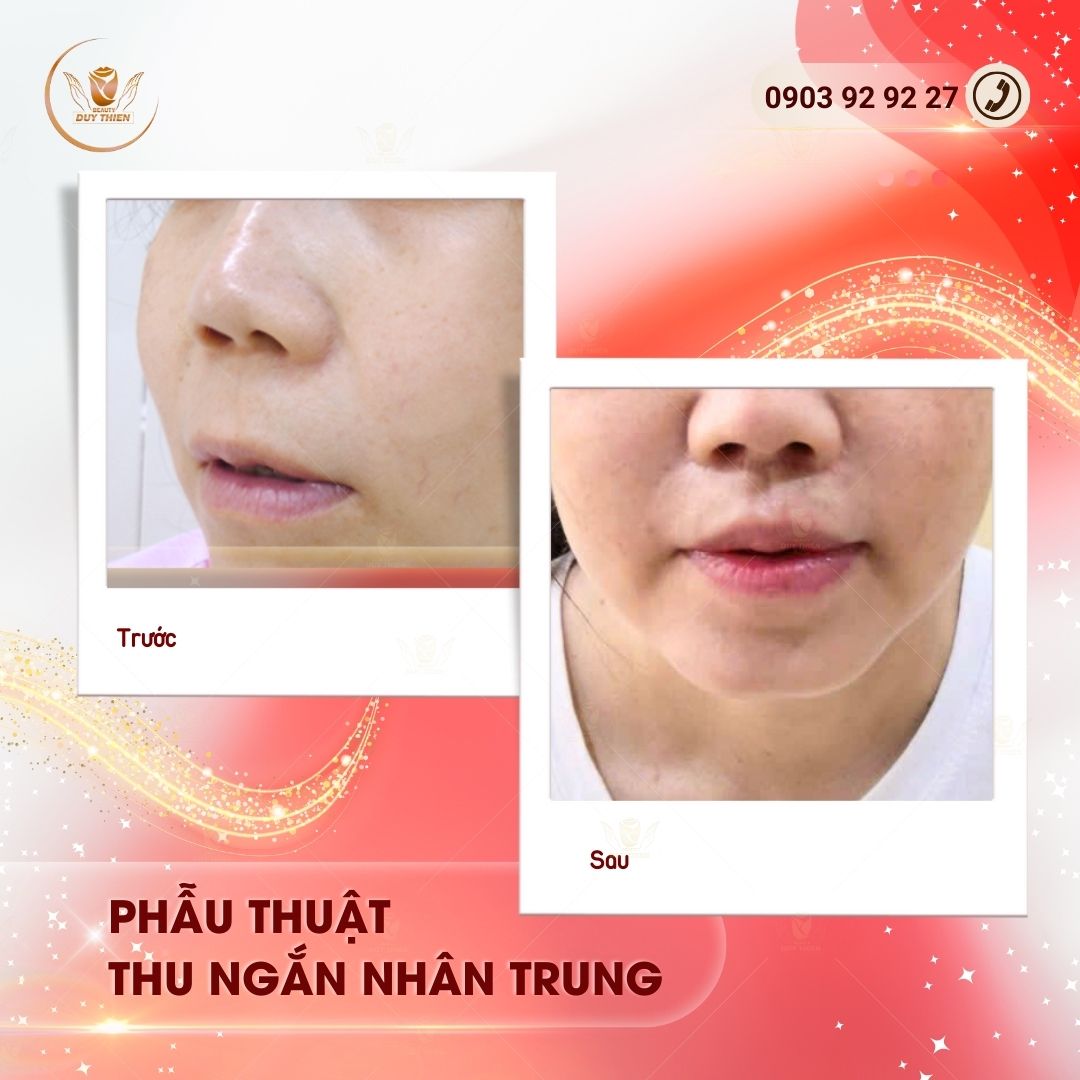 Thu ngắn nhân trung - cải thiện tỷ lệ gương mặt