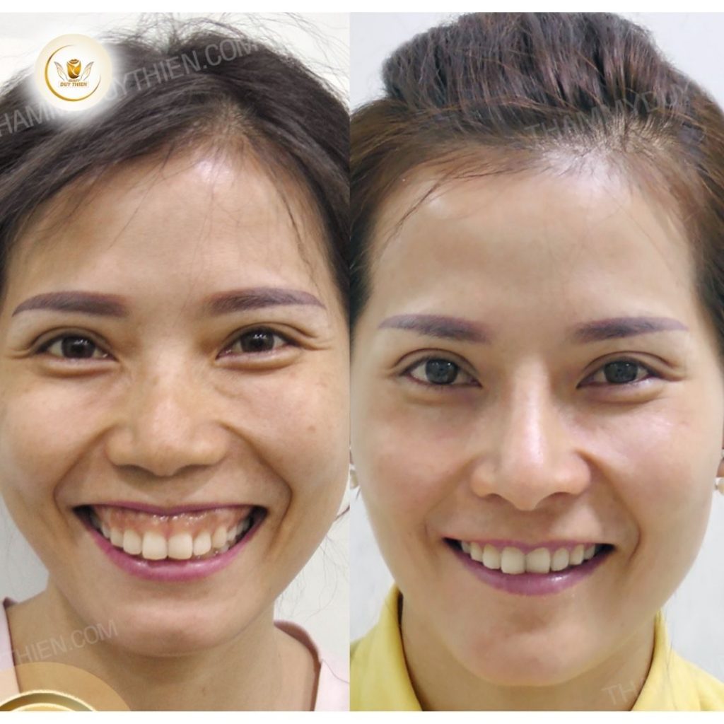 Các phương pháp cười hở lợi