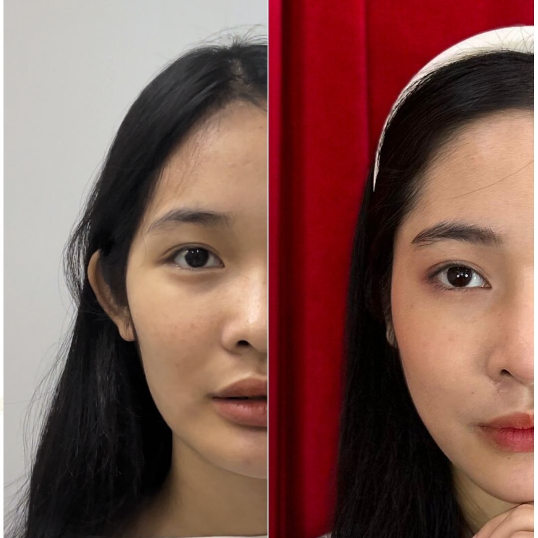 Trước và sau độn thái dương 1 tháng