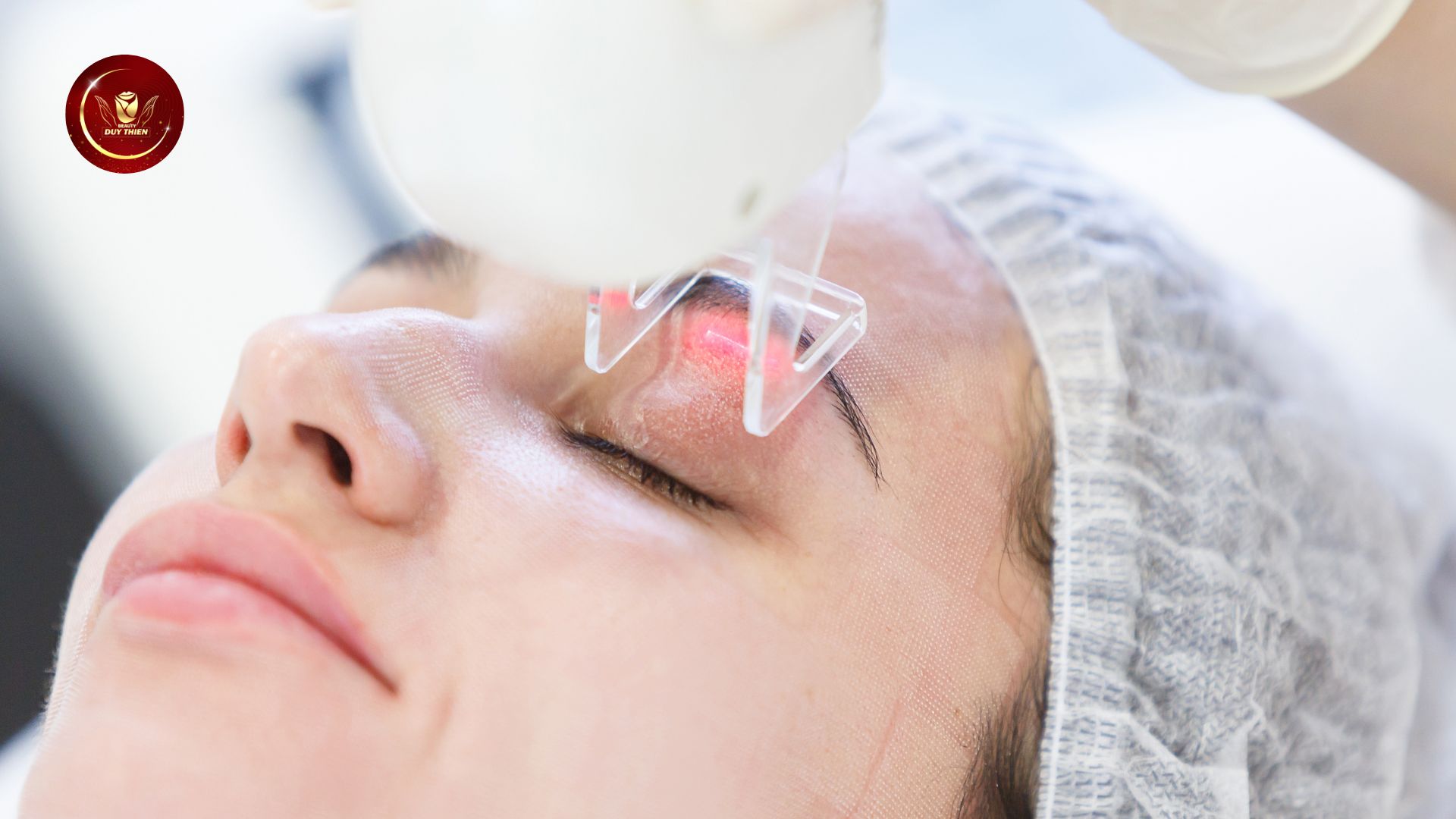 điều trị quầng thâm mắt bằng laser