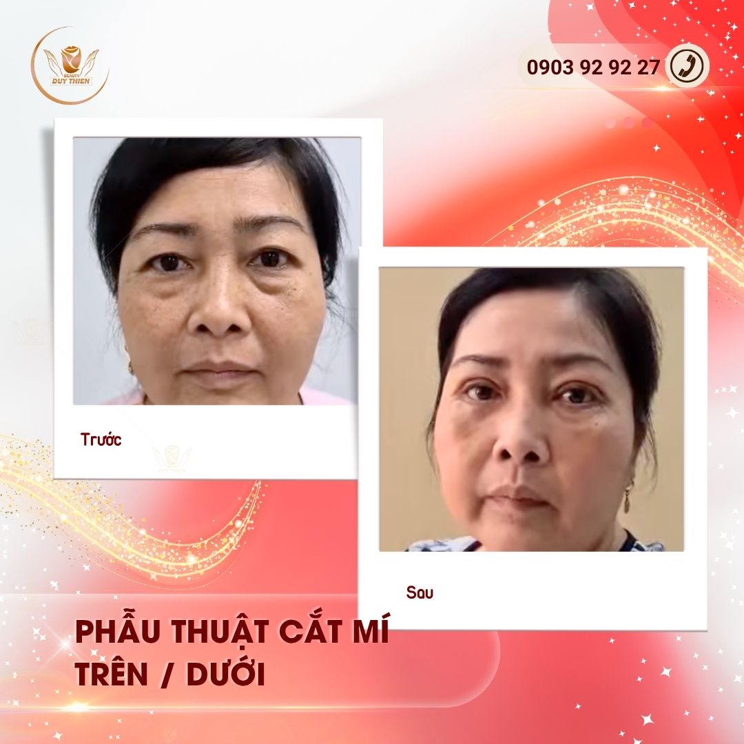 kêt-qua-cat-mi-mat-tu-nhien