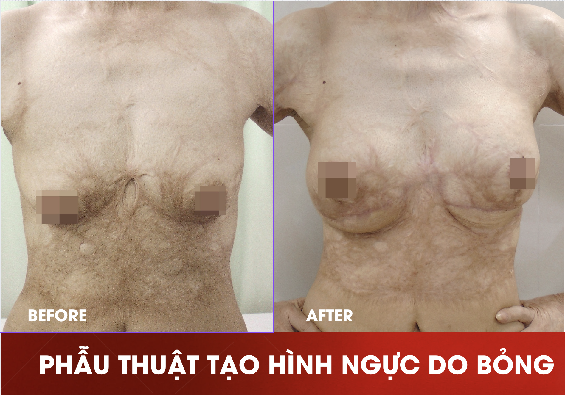 tao-hinh-tham-my-nguc-do-seo