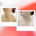 Tạo-hình-thẩm-mỹ-sẹo-do-bỏng