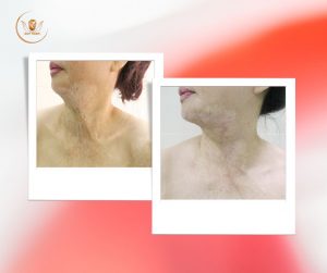 Tạo-hình-thẩm-mỹ-sẹo-do-bỏng