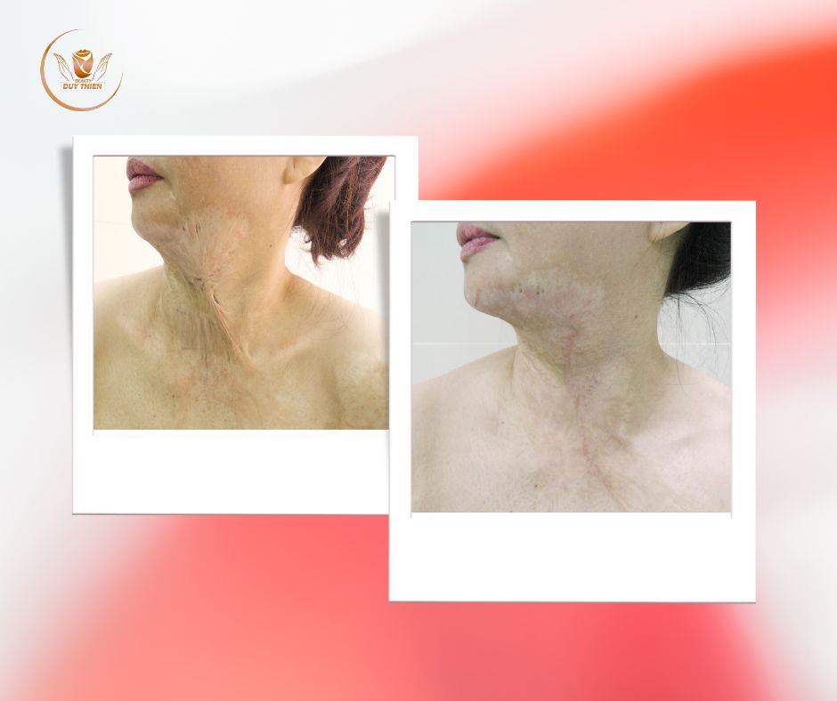 Tạo-hình-thẩm-mỹ-sẹo-do-bỏng