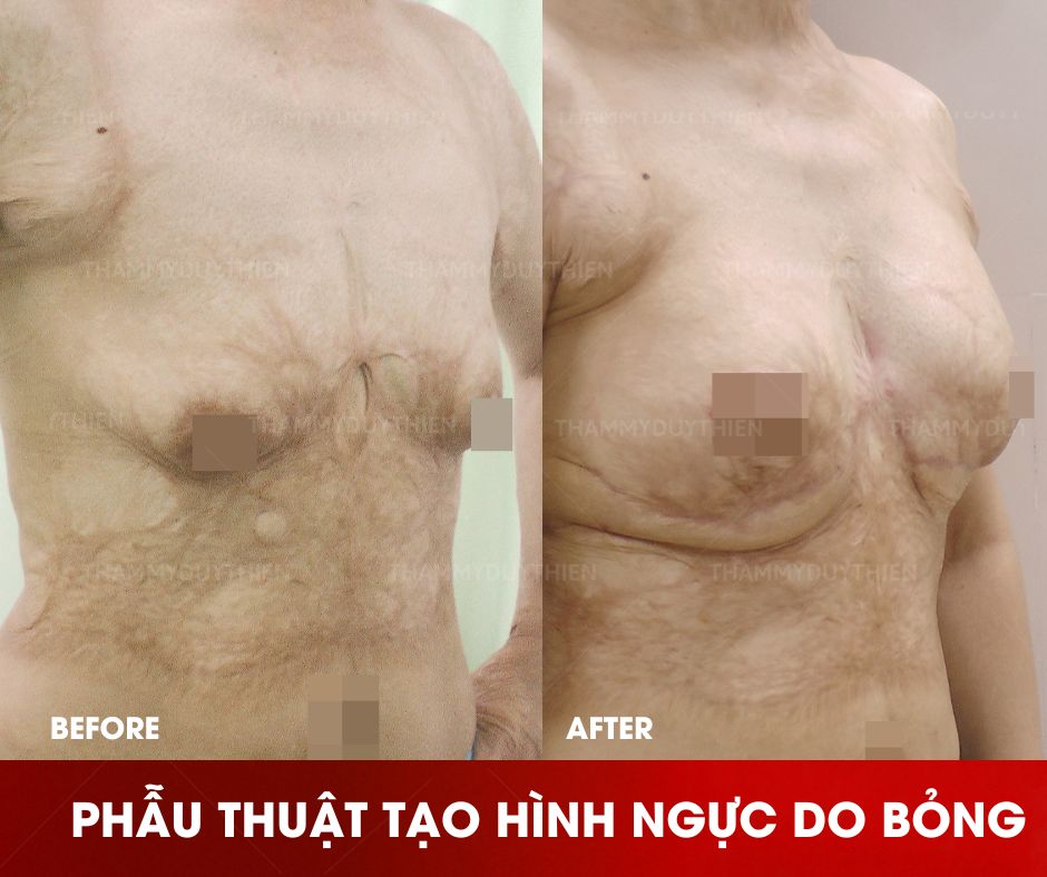 Tạo-hình-thẩm-mỹ-ngực-do-bị-bỏng
