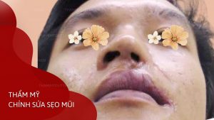 chinh-sua-seo-mui-do-tai-nan