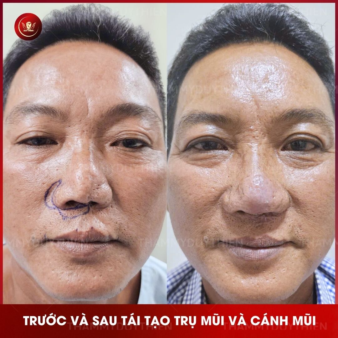 chinh-sua-seo-mui-do-tai-nan