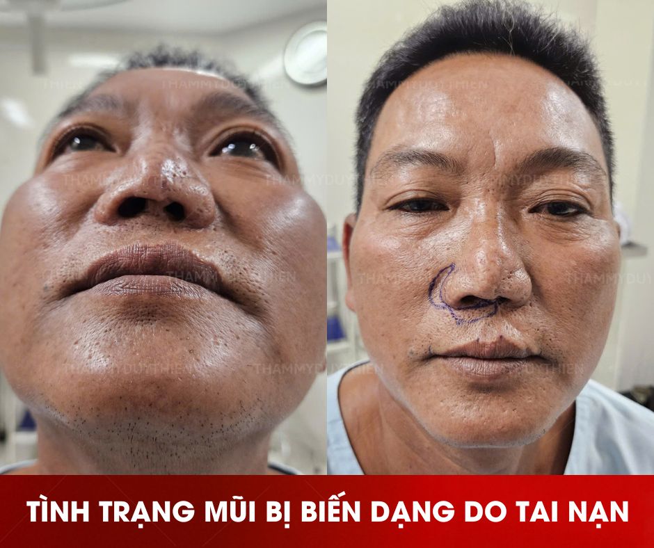 chinh-sua-mui-do-tai-nan