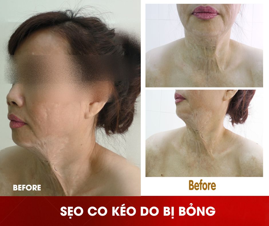 tao-hinh-thẩm-mỹ-seo-do-bỏng