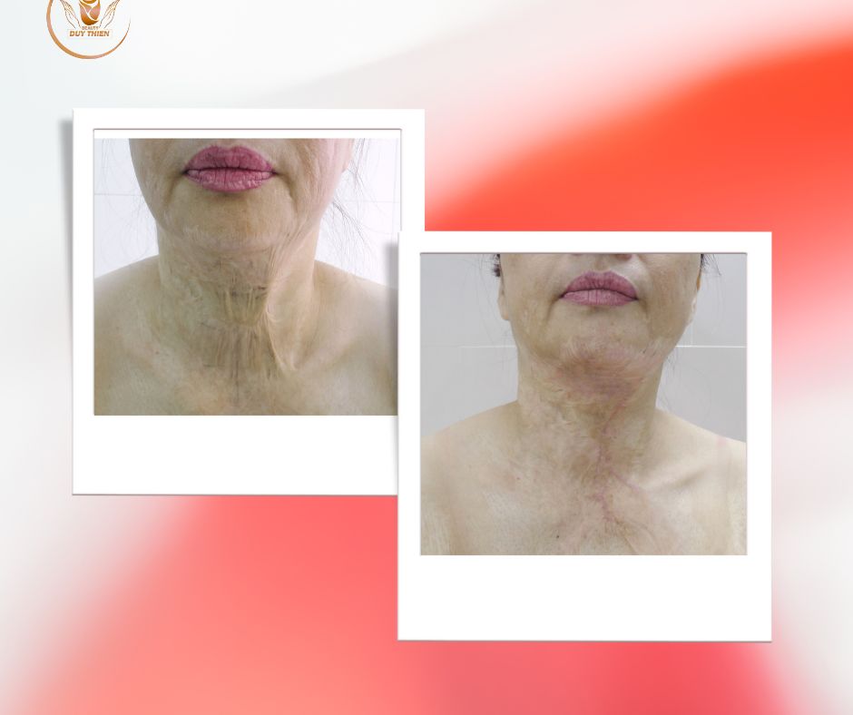 tạo-hình-thẩm-mỹ-sẹo-cổ-do-bị-bỏng