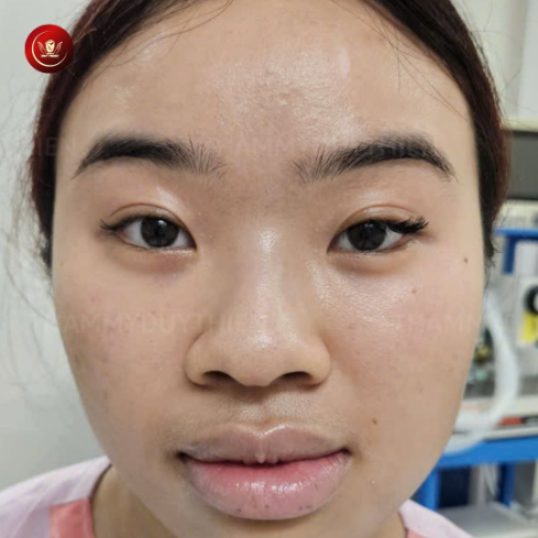 truoc-khi-mo-goc-mat-dep-tu-nhien