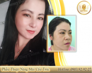 nang-mui-tai-cau-truc