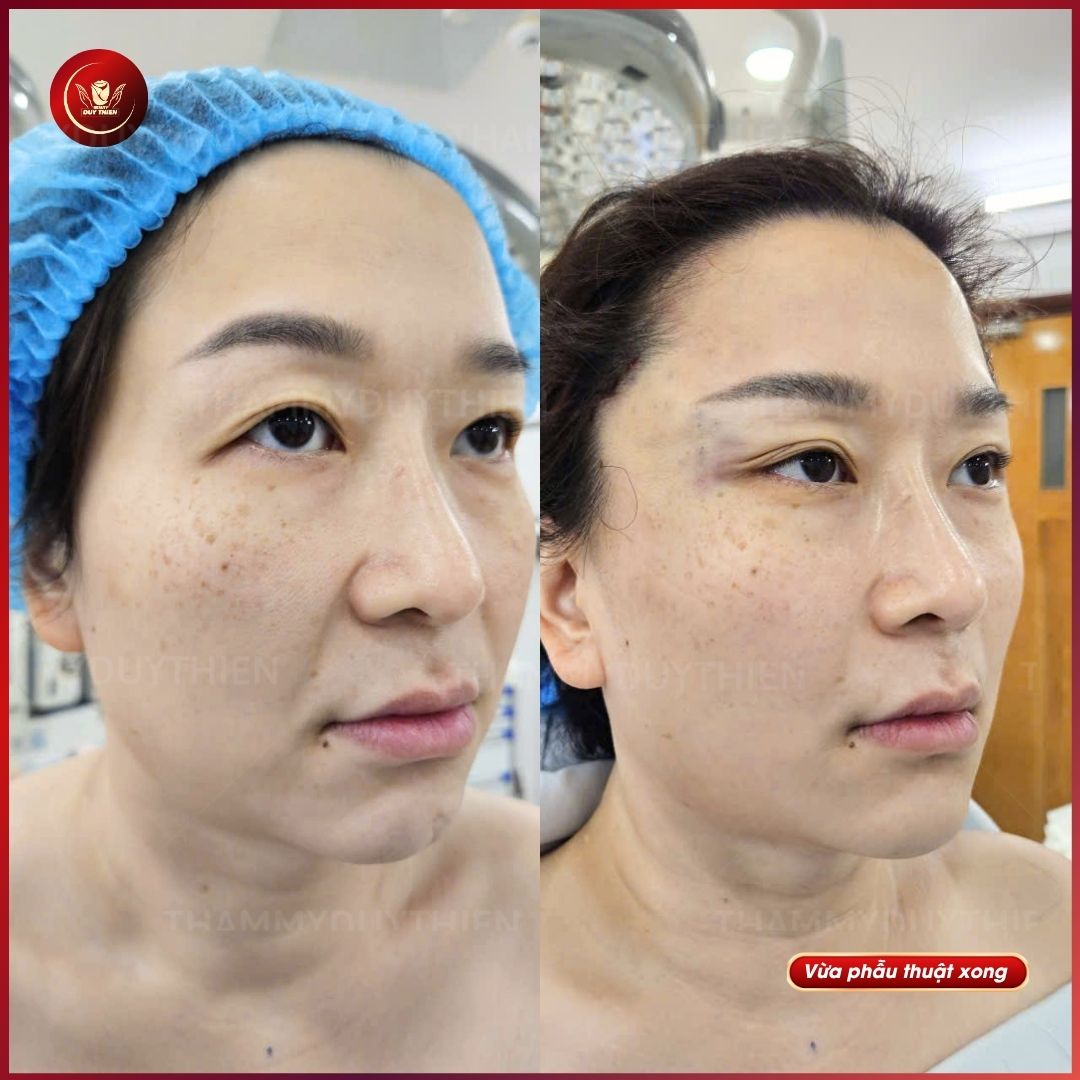Kỹ thuật treo mày nội soi cải tiến bởi bác sĩ Duy Thiện không để lại sẹo.