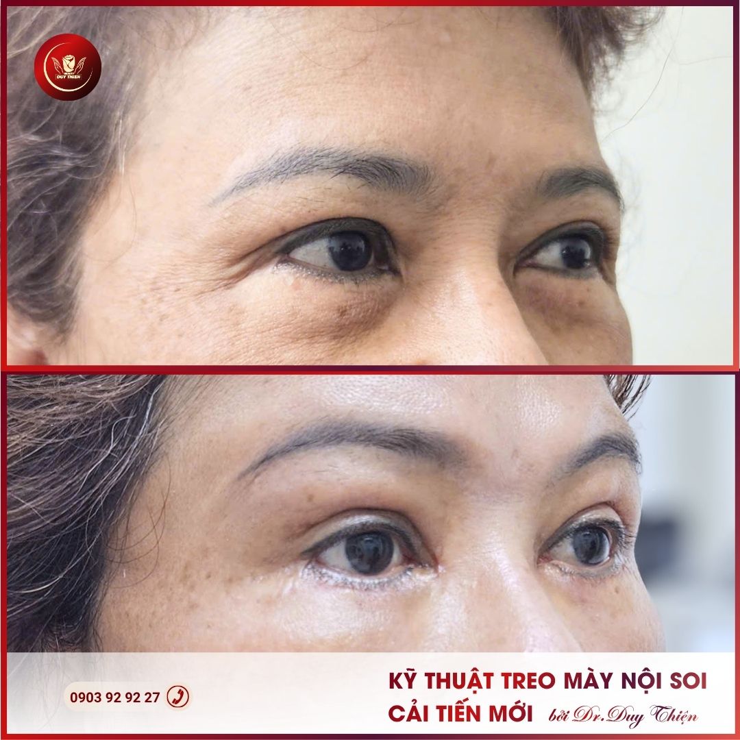 Kỹ thuật treo mày nội soi không để lại sẹo