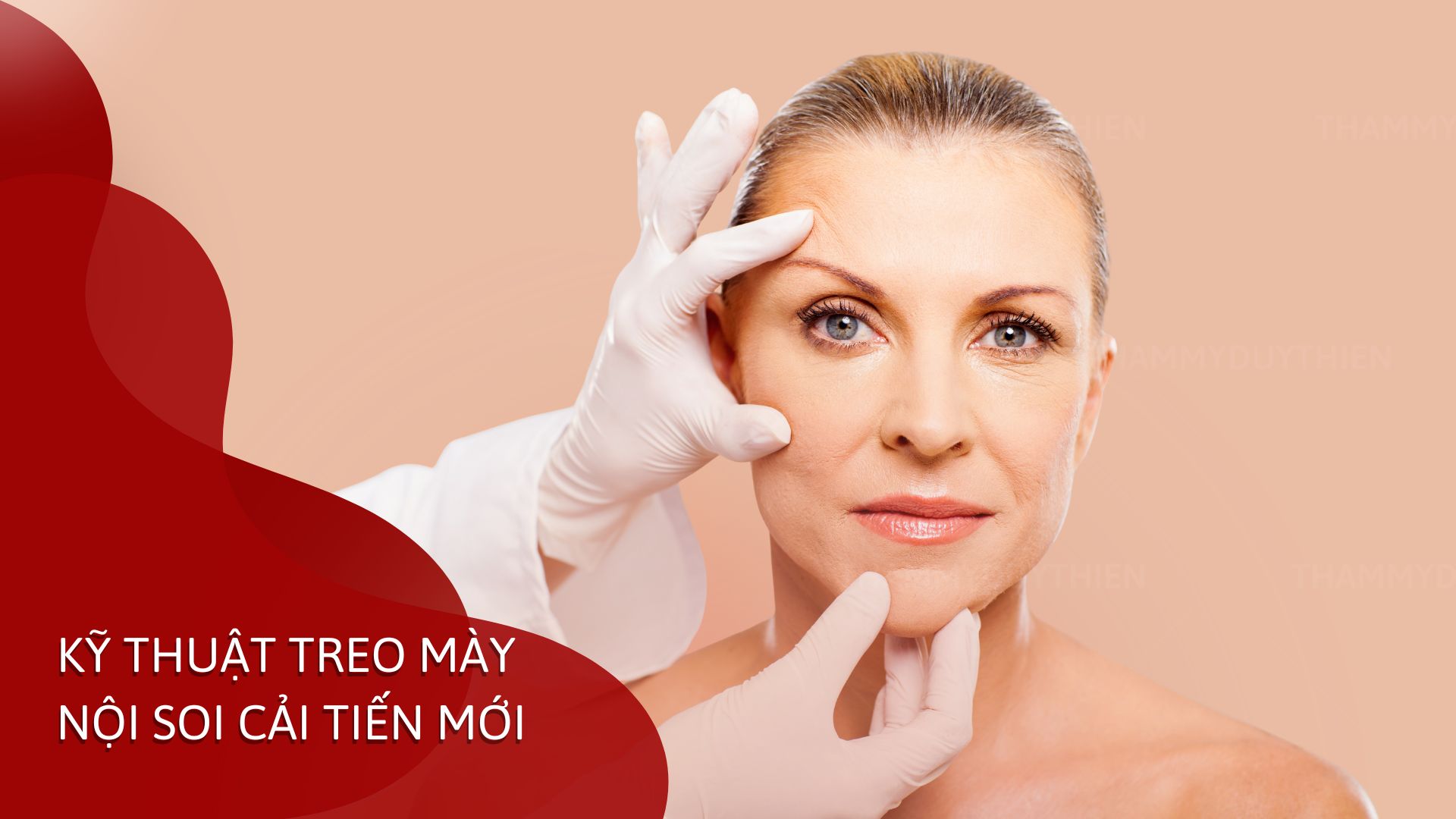 Kỹ thuật treo mày nội soi cho tuổi trung niên