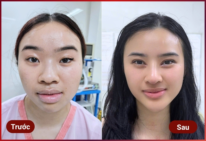 Phẫu thuật thẩm mỹ khuôn mặt theo nhân tướng học