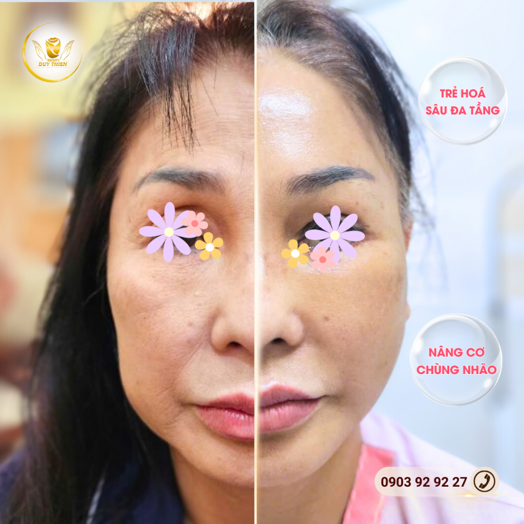 Hút mỡ má tuổi trung niên kết hợp căng da mặt nội soi cải tiến mới