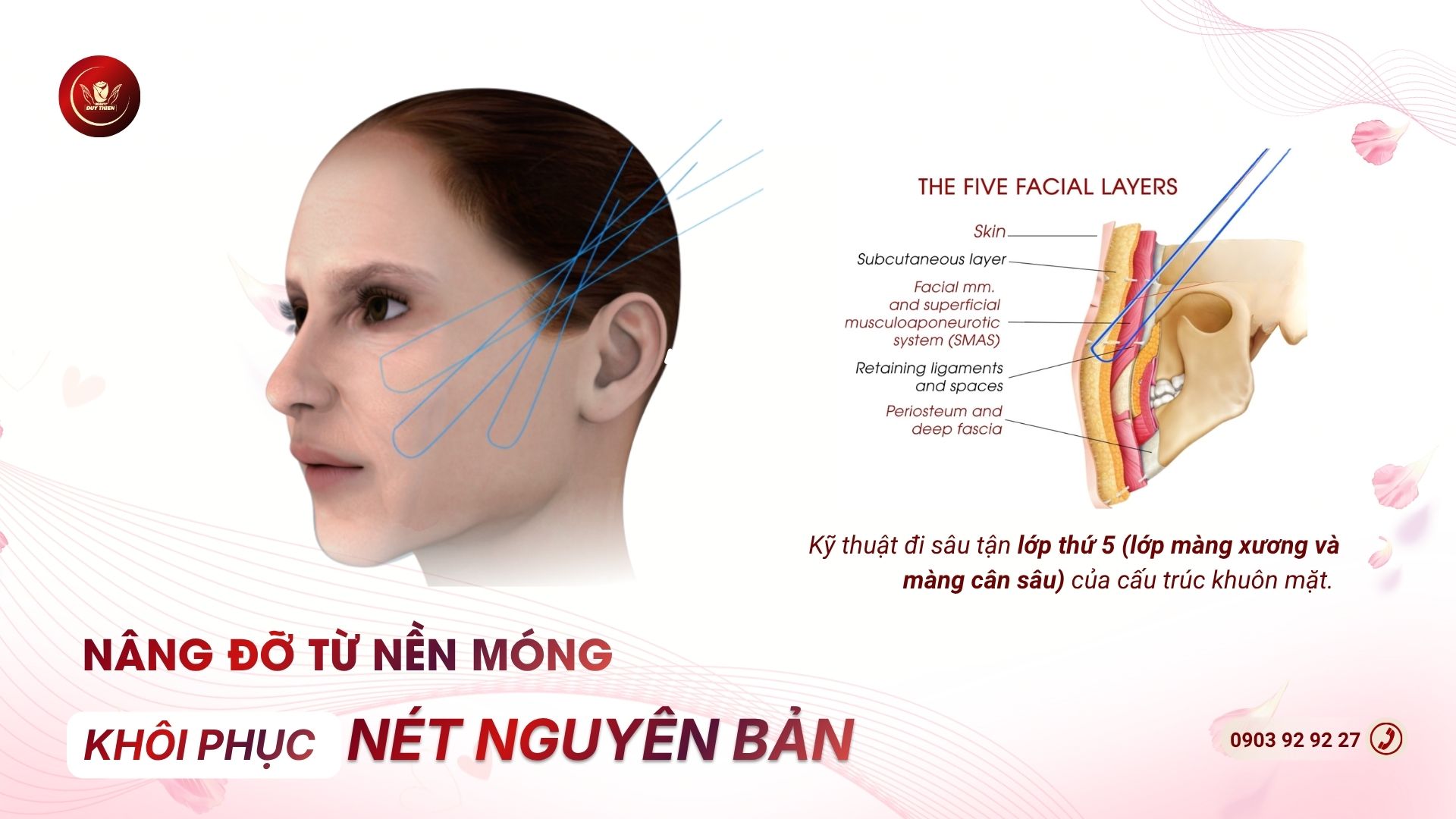 Hút mỡ má tuổi trung niên kết hợp căng da mặt nội soi