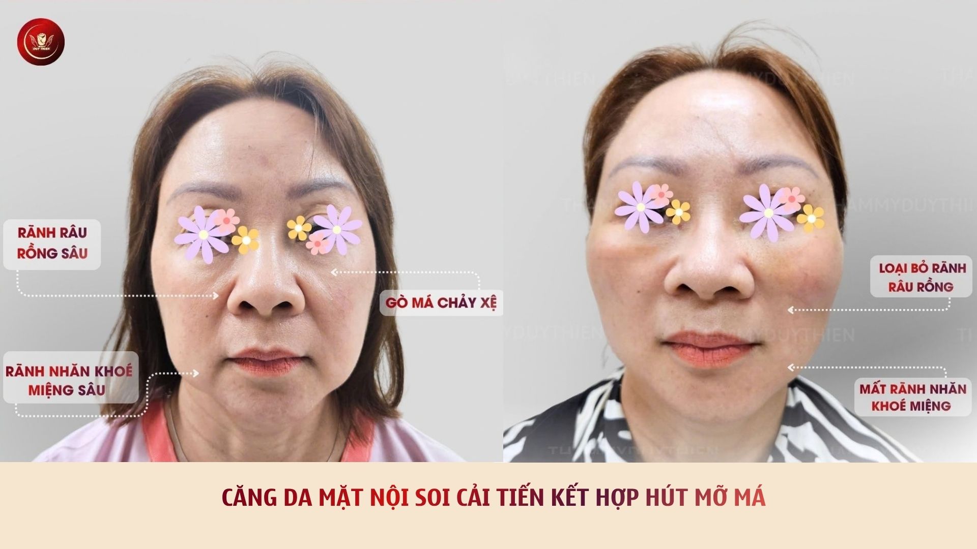hút mỡ má kết hợp căng da nội soi